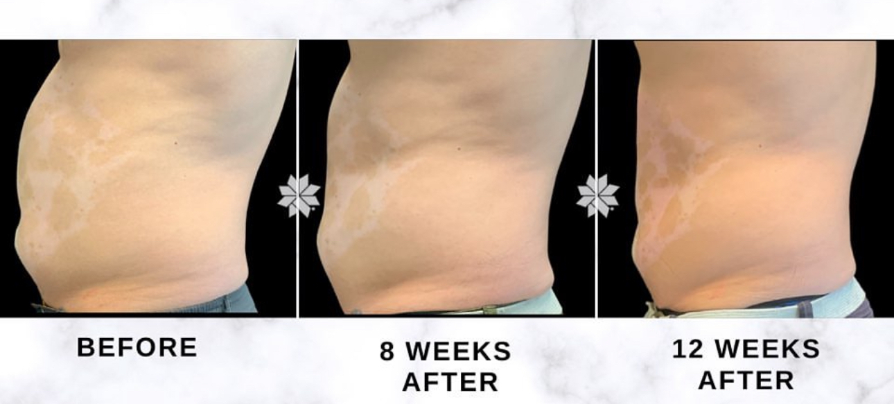 Abdomen side-view before, eight weeks after, and twelve weeks after. Individual results vary.