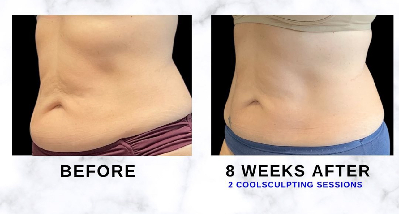 Abdomen side-view before and eight weeks after two CoolSculpting sessions. Individual results vary.