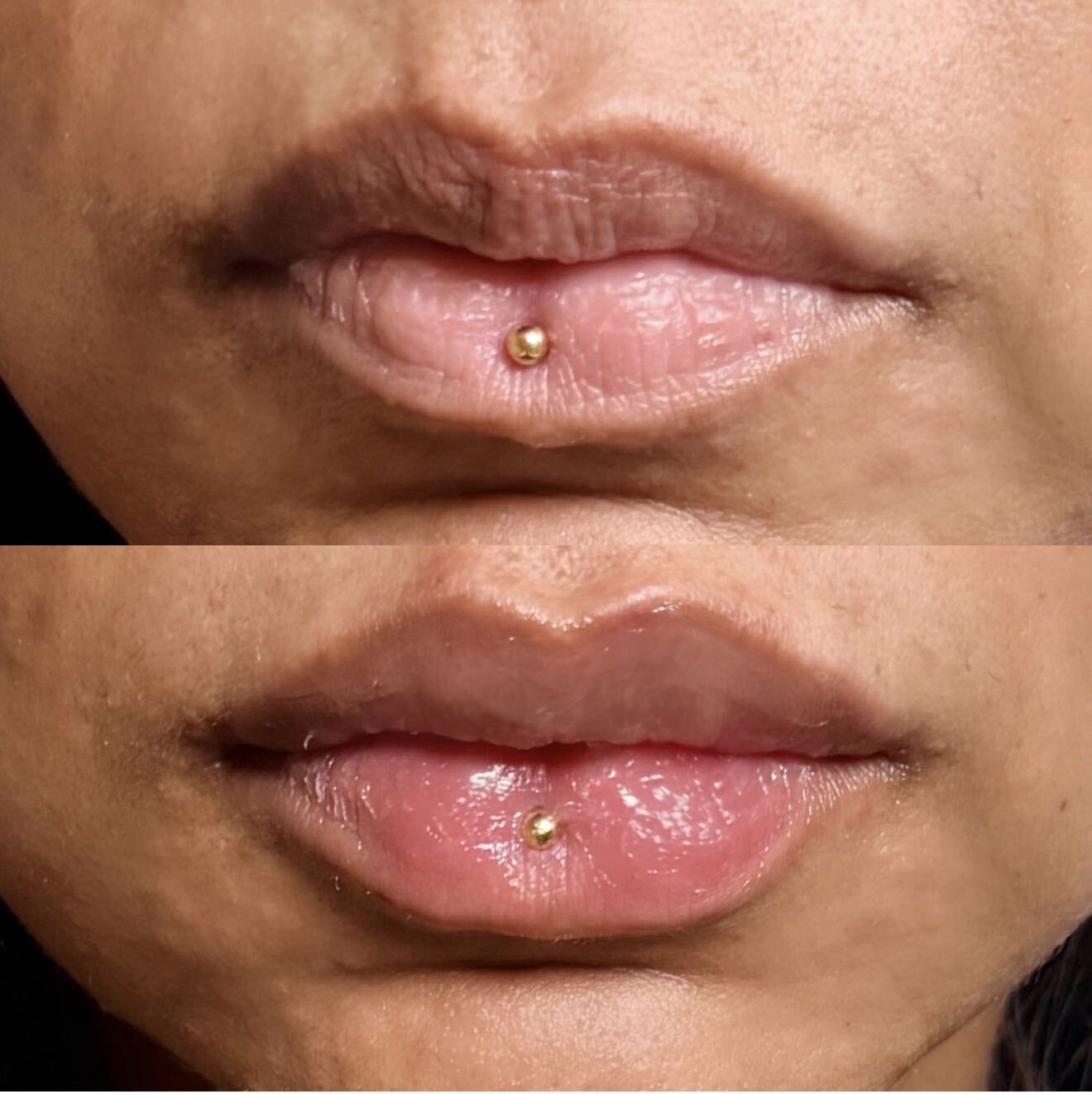 KB Lips front-view before-and-after dermal filler result. Individual results vary.