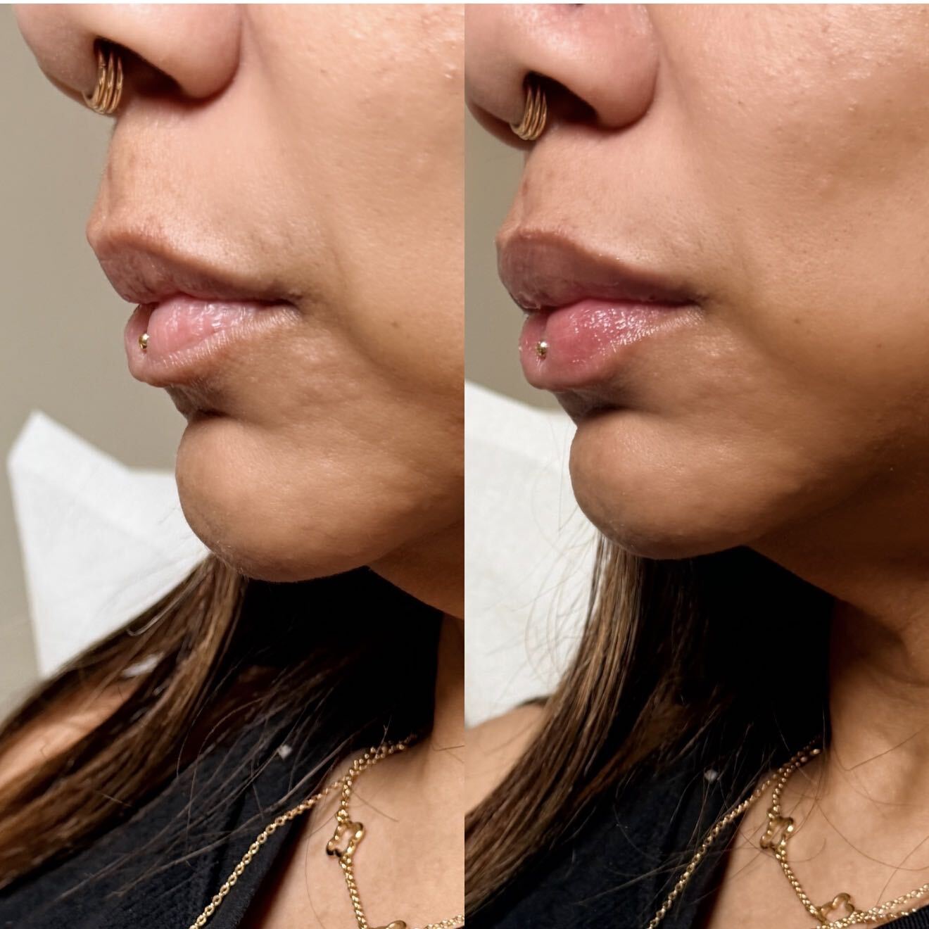 KB Lips side-view before-and-after dermal filler result. Individual results vary.